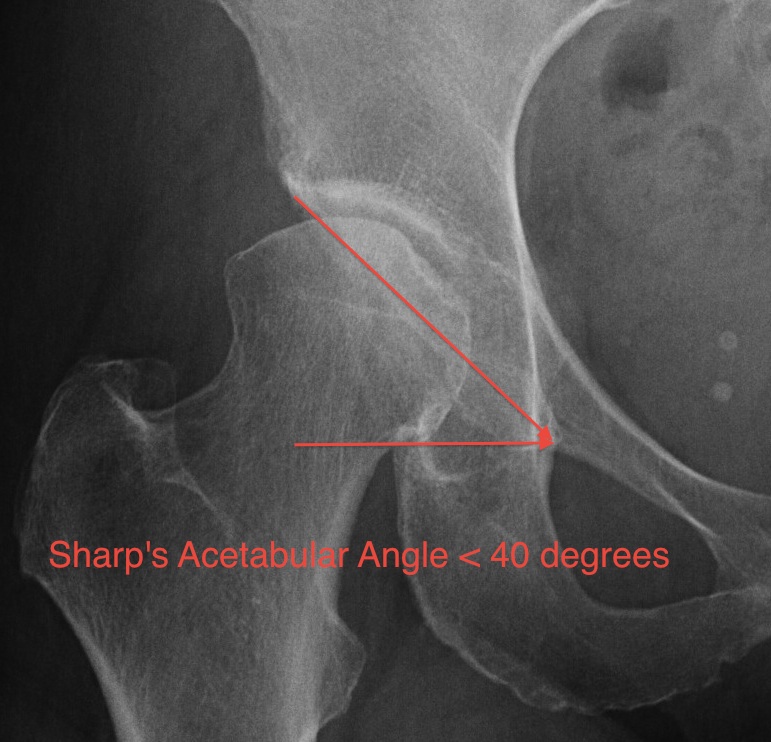 Sharp's Acetabular Angle > 40